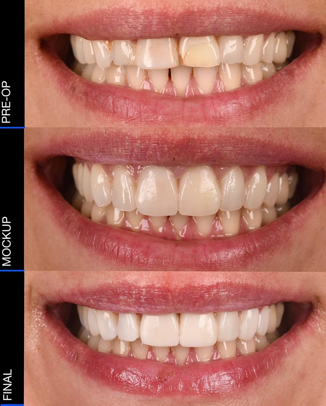 FREEHAND & INJECTABLE COMPOSITE VENEERS with Dr Khalil & Dr Andrew