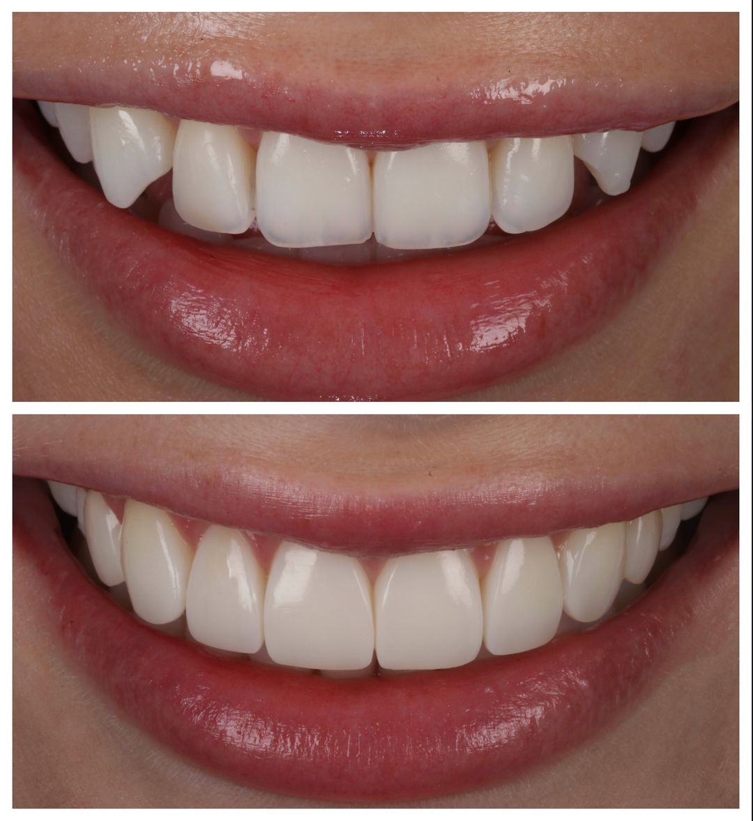 FREEHAND & INJECTABLE COMPOSITE VENEERS with Dr Khalil & Dr Andrew