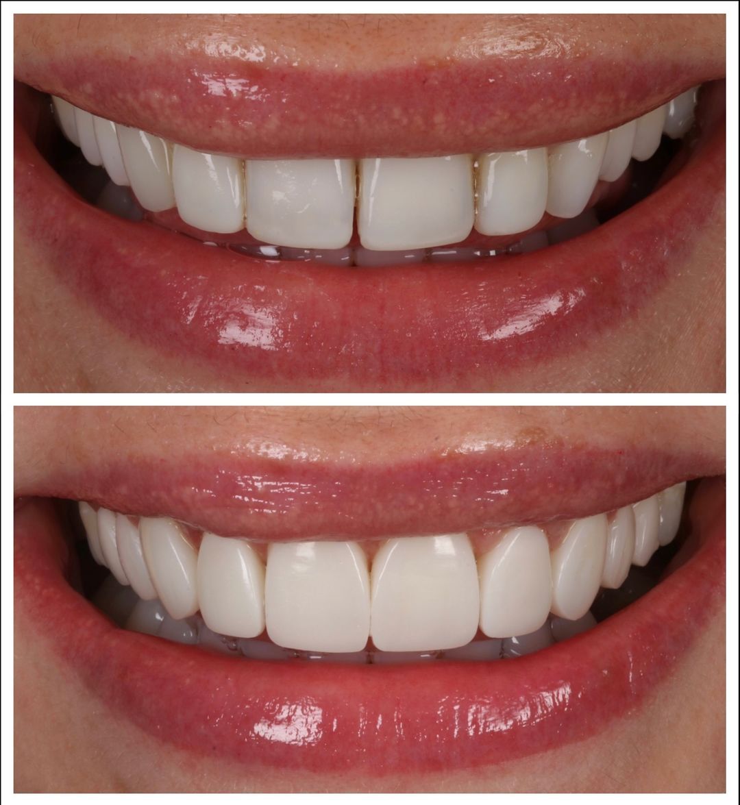 FREEHAND & INJECTABLE COMPOSITE VENEERS with Dr Khalil & Dr Andrew