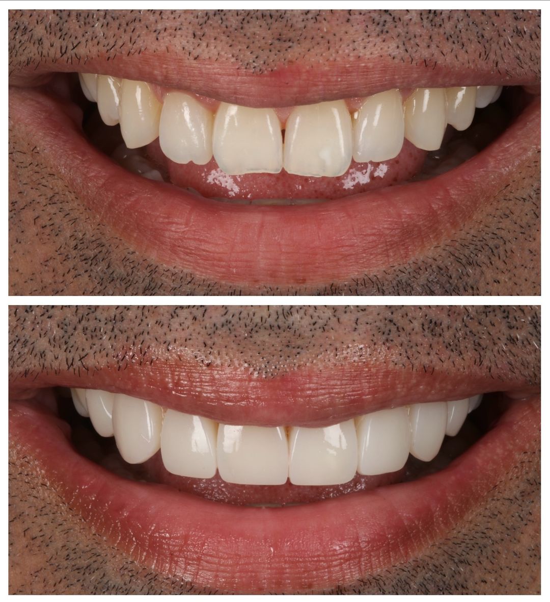 FREEHAND & INJECTABLE COMPOSITE VENEERS with Dr Khalil & Dr Andrew