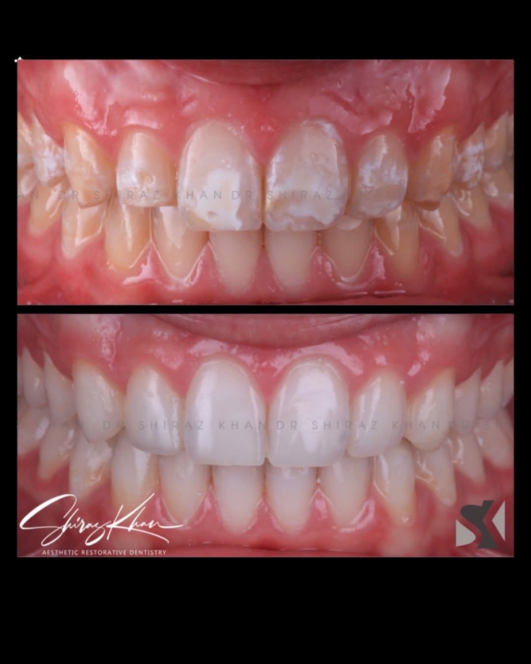 AESTHETIC DENTAL PHOTOGRAPHY with Dr Shiraz Khan