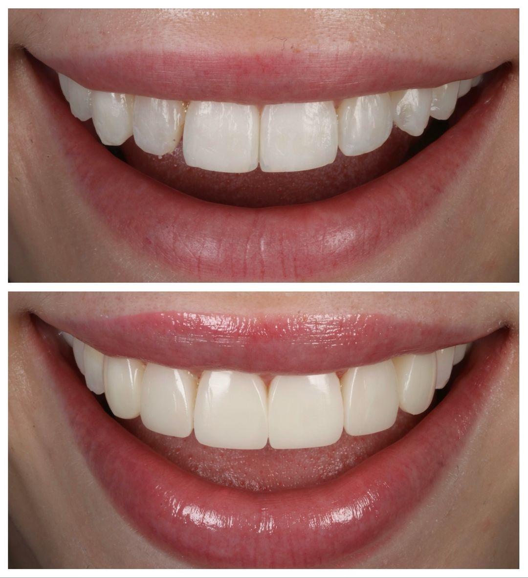 FREEHAND & INJECTABLE COMPOSITE VENEERS with Dr Khalil & Dr Andrew