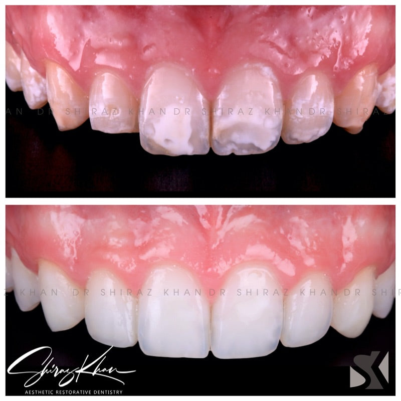 ICON INFILTRATION & RUBBER DAM MASTERY with Dr Shiraz Khan